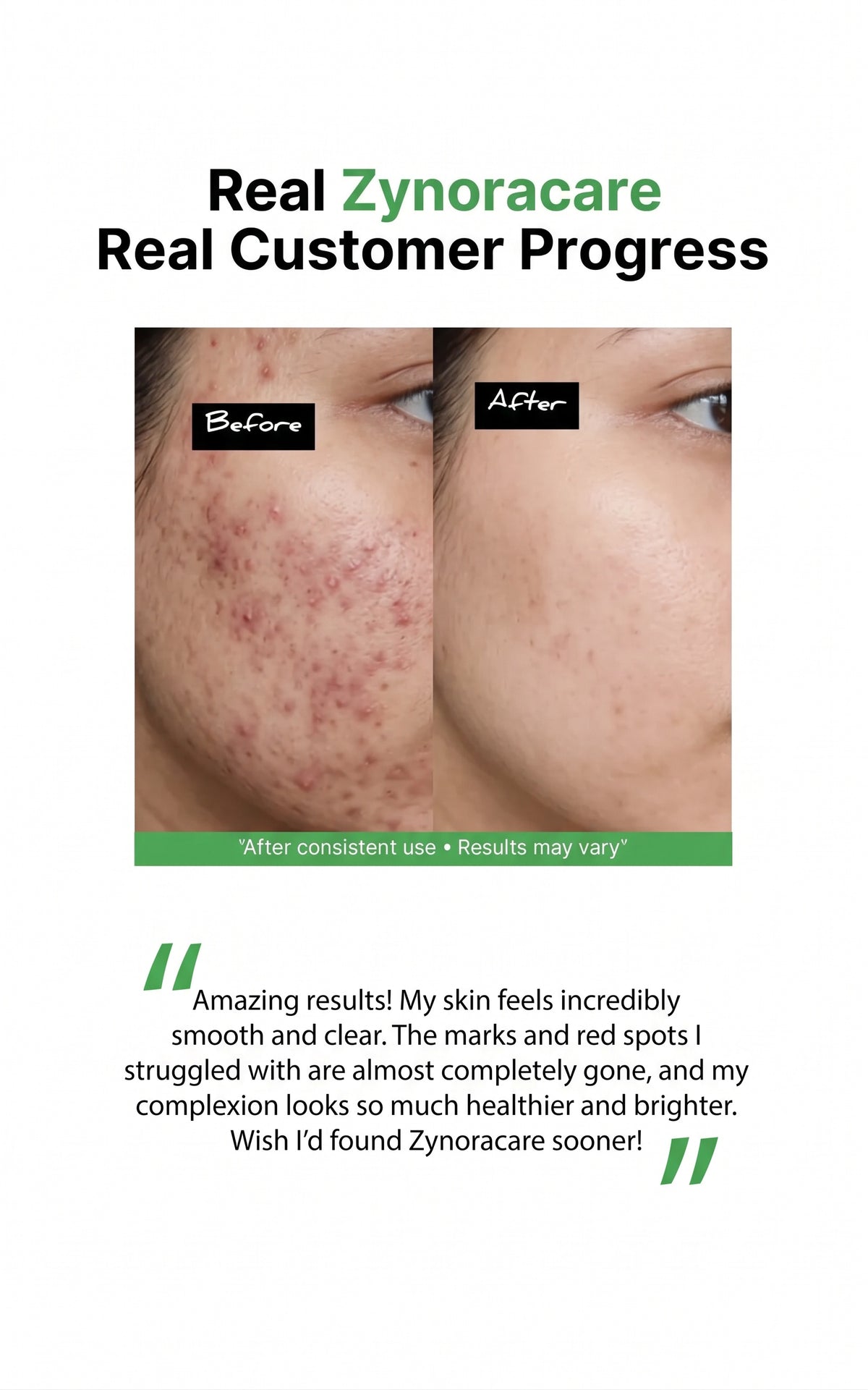 A promotional graphic for Zynoracare featuring a before-and-after skin comparison photo of a person's cheek, with text reading 'Real Zynoracare Real Customer Progress' and a customer testimonial below on a white background.